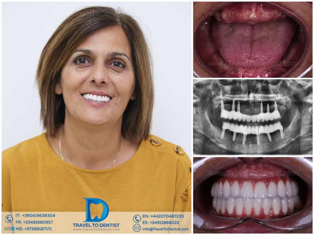 Transformación dental - Caso clínico 5
