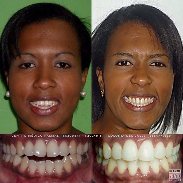 Transformación dental - Caso clínico 6