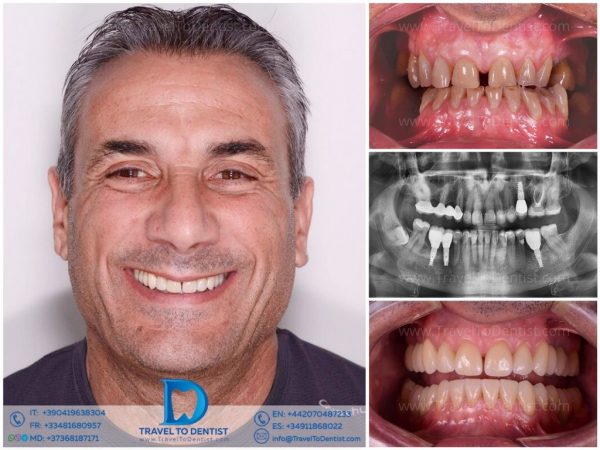 Transformación dental - Caso clínico 2